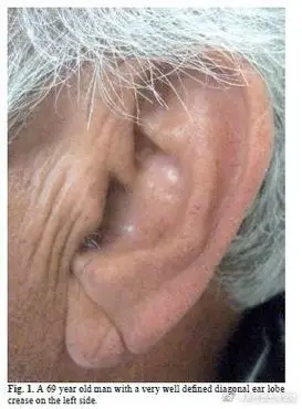 原来耳褶心征是真的