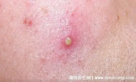 毛囊炎的症状和图片,针头大的红疹长成脓疱中央有毛发贯穿