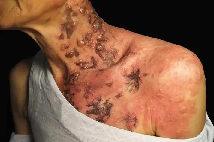 带状疱疹图毛囊炎:艾滋病患者锁骨处出现毛囊炎时,可表现为炎性毛囊性