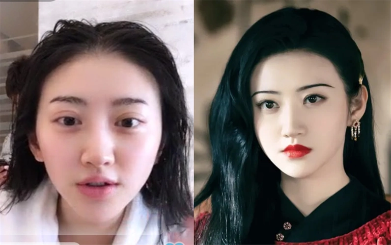 景甜,许魏洲修复双眼皮