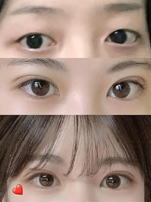 超级自然的双眼皮全切!闭眼无痕.