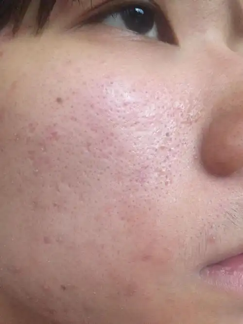 这些可以治好吗?毛孔粗大和痘痘,还有vc含片