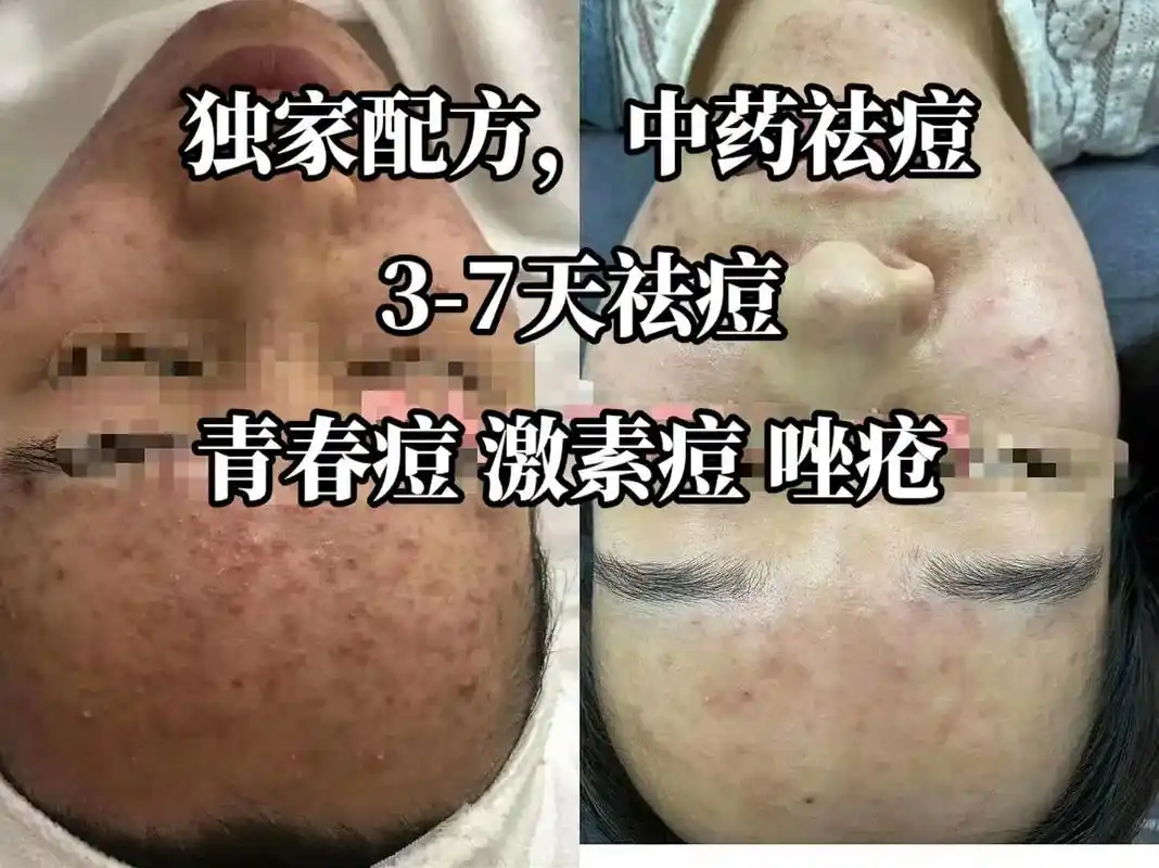独家配方中药祛痘