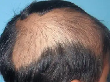 拔毛癖头皮露出一大片图