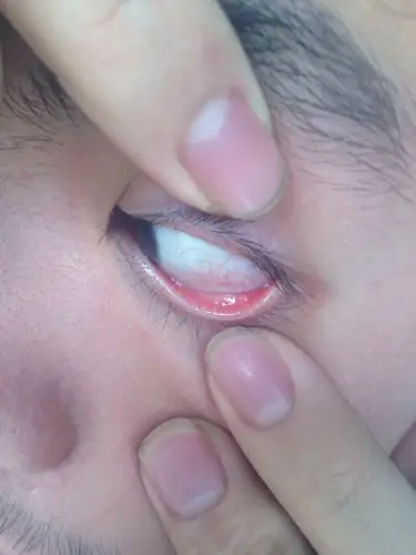 去医院看,医生说是眼角膜溃疡.