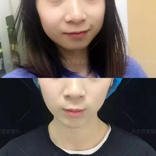 玻尿酸填充下巴前要注意颏肌放松