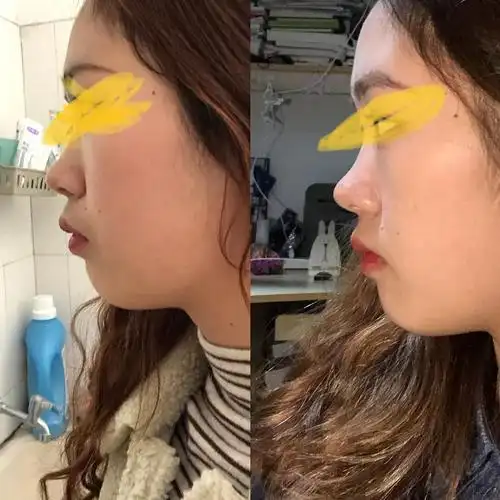 戴牙套一年的变化!