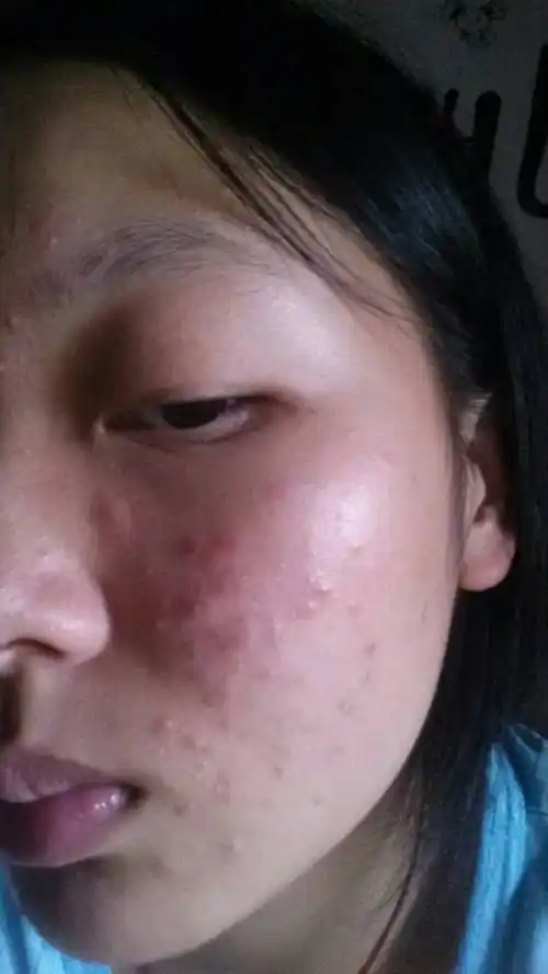 这几天长的痘,好痒,是什么原因造成的,望医生解答