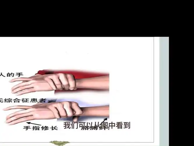 22级预防1班15-马凡综合征-侯帅,李佳宁,陈静瑶,尹昌婷