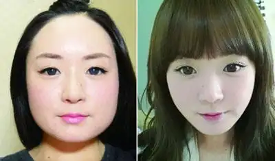 多元化下颌角整形日记大饼脸变成小v脸