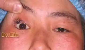 睑缘色素痣-病例3 - 好大夫在线