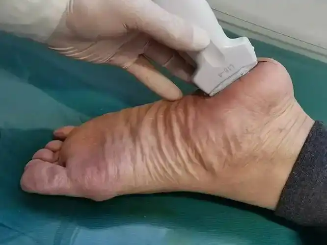 足底筋膜炎超声可视化来助力