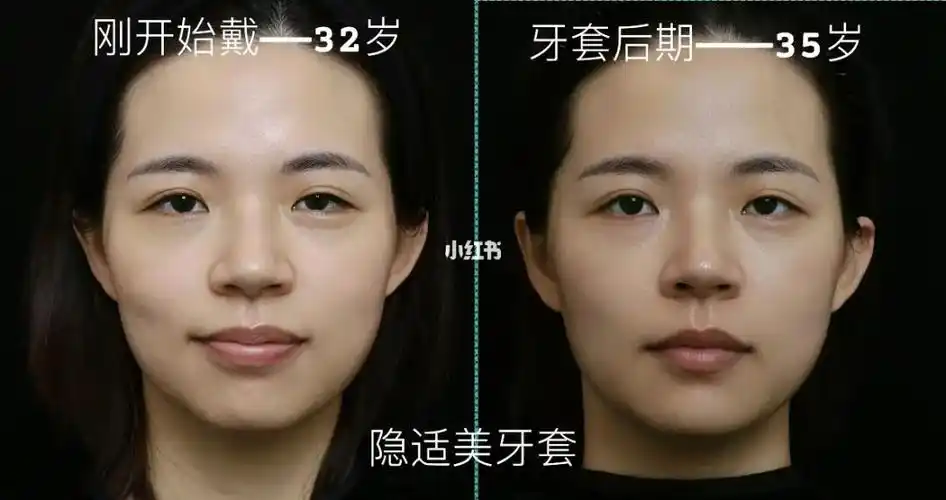 覆的变化,但确实看起来更好看了么～～～所以想戴牙套的美眉不要犹豫