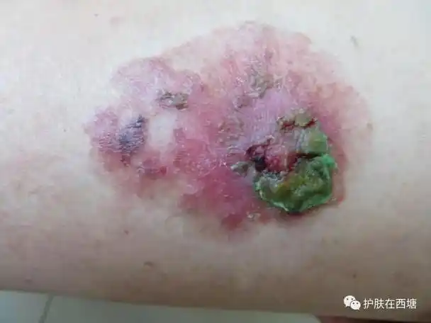 不痛不痒的一片红斑,居然是皮肤癌!