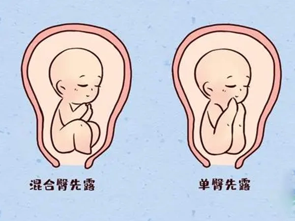 难过!大家常说的胎儿臀位是什么意思?"今非昔比"-第1张图片-蒲城博客