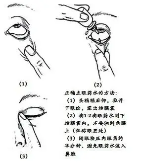 如何正确点眼药水,眼膏/眼用凝胶