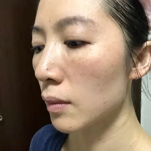 我的皮肤角质层薄,两颊有红血丝,易过敏.脸色暗沉,_圈子-新氧美容整形