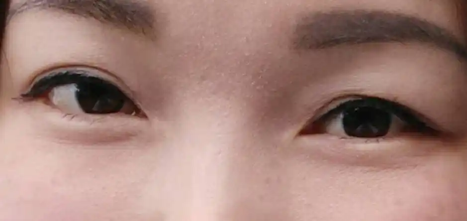 眼睑下垂,怎么办?要去微整形吗?有什么好办法改善? 眼睑下垂,怎么办?