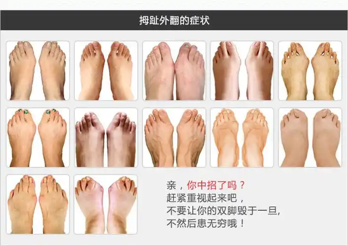 护腰的适宜人群  趾骨发大,拇趾囊肿,骨骼增生,令穿鞋时前足产生痛楚