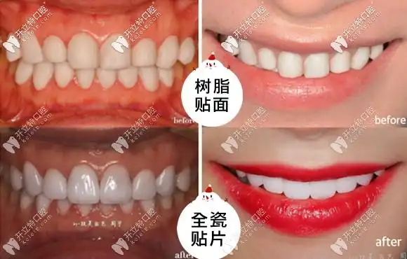 树脂贴面和全瓷贴面的效果对比