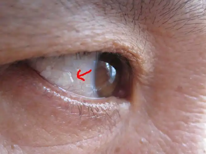 眼睛里长个几个小疙瘩