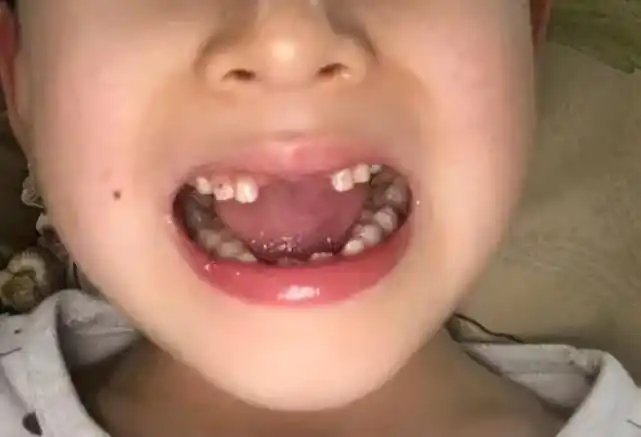 12-14岁,第二磨牙;12岁,第二双尖牙;11岁,单尖牙;10岁,第一双尖牙;8-9