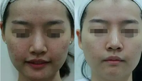 (图为:美贝尔注射美白针治疗前后对比图)