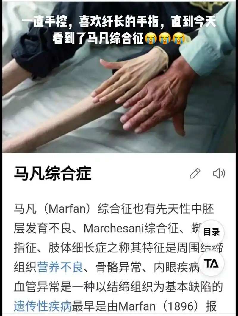 马凡综合征,好看的手.一直手控,喜欢纤长的手指,直到今天看到 - 抖音