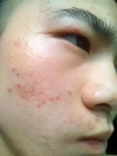 请问脸上的这些小点点是什么,几乎每个小点点里都有汗毛,这是毛囊炎么