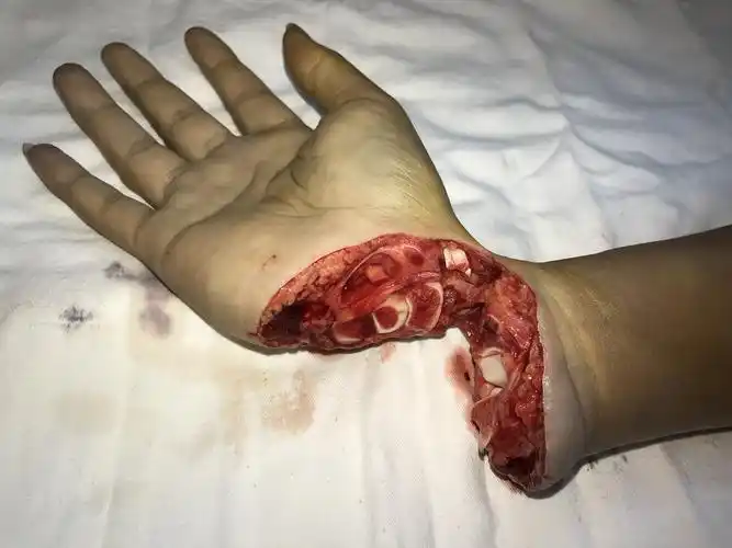 成功挽救一名手腕部完全离断伤患者,手术历时8小时,当看到手术后患者