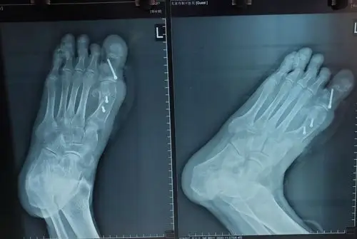 高跟鞋美女通病,拇外翻你真的了解吗?