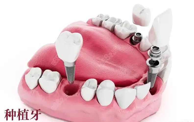 株洲华美口腔种植牙怎么样