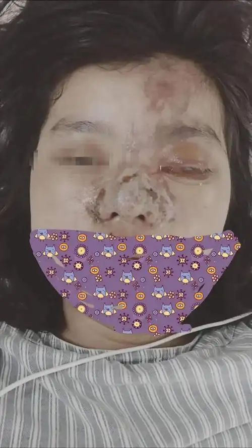 河南电视台曝光滑县女子微整失败致眼睛失明