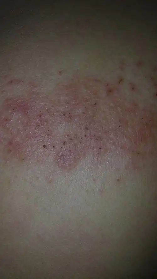 孕十周身上长癣很痒,怎么办?求帮忙