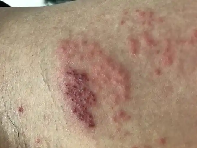 2月2号晚上我发现大腿内侧有一个巨大的红疹以为是湿疹涂了派