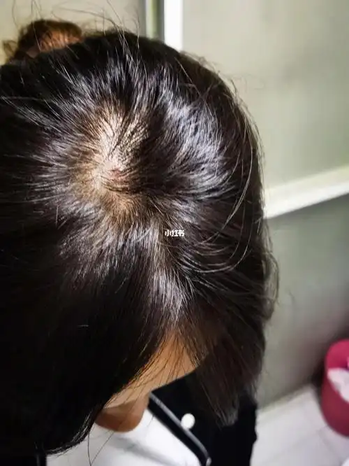 脱发 毛囊炎 头皮脂溢性皮炎_脂溢性皮炎_脱发_毛囊炎_巴黎卡诗怎么样