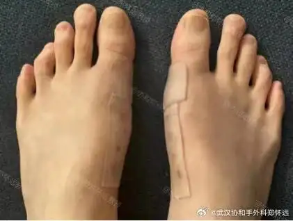 近期,有些拇外翻患者在门诊咨询时,当听到微创手术需要用螺钉内龚定