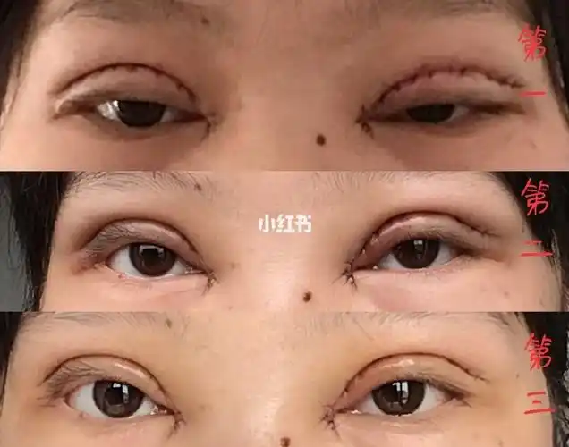 开眼角 全切双眼皮(割后分享)_开眼角_双眼皮手术_双眼皮_自然款_肿
