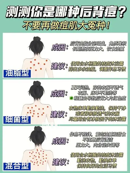 后背痘成因自查这个夏天和后背痘和解