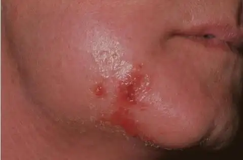 红霉素软膏是万能的?医生辟谣:红霉素有什么用?能治疗什么病?