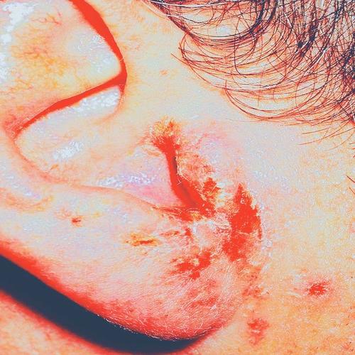 阿莫西林拉维酸钾耳朵痒真菌耳痒痒外耳道湿  疹起皮耳朵红耳藓耳