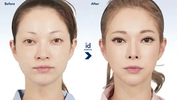 在id整形医院做了脸骨手术后蜕变成功的真人案例看看什么叫颜值