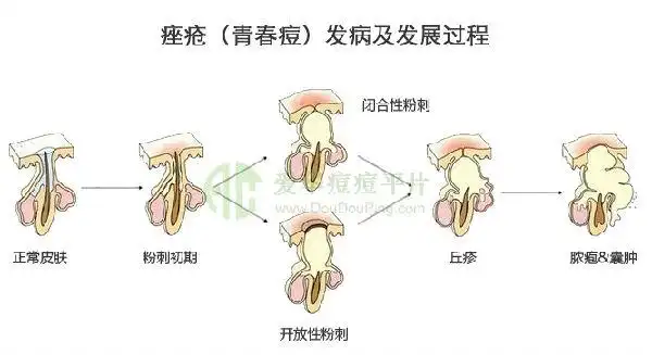 如何去黑头,先从了解它开始