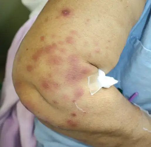 骨髓增生异常综合征并发白血病性血管炎的皮肤病损(a)右臂可见水肿样