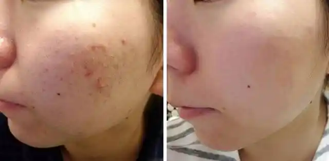 "满脸的痘痘,都被排光了"