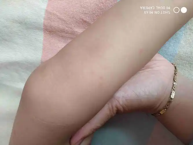 口里都是溃疡,身上有这种星星点点的红点,医生检查是轻微手足口,用