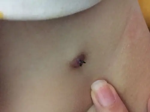 (鞘膜积液,疝气)手术后遇到伤口线结反应怎么办_鞘膜积液_治疗方式