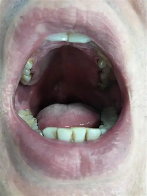 汉阴县医院成功开展改良悬雍垂腭咽成形术