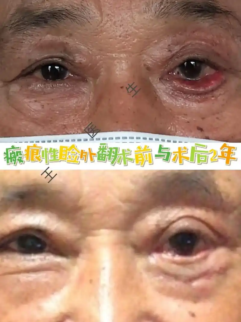 眼睑外翻常常会导致暴露性角膜炎,甚至发展为角膜 - 抖音