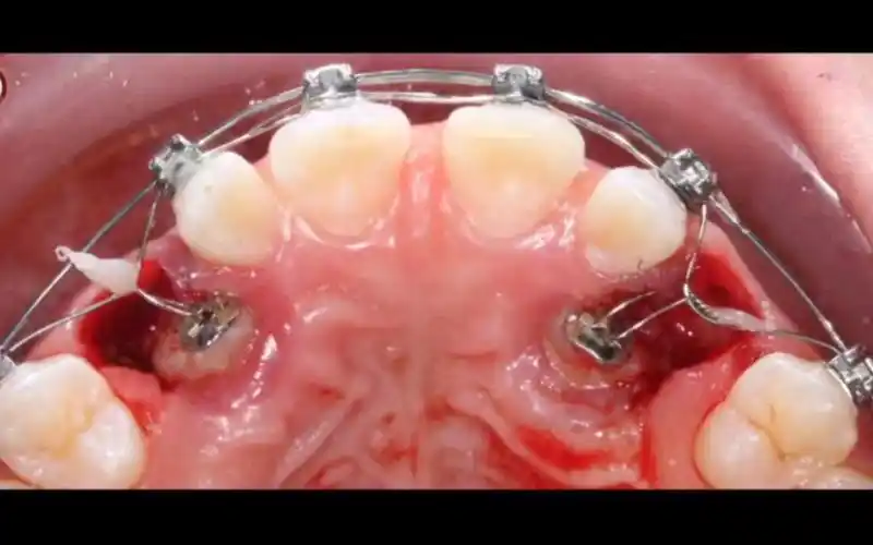 腭侧阻生尖牙病例它又来了